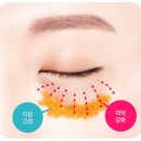 오호성형외과의원 | 60대 눈처짐, 눈밑꺼짐 강남 하안검 후기와 회복 과정. 비용과 함께 알아보자.