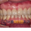[신당역 서울닥터한치과 / 무삭제 라미네이트]