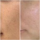 디오레 | 홍대피부과 홍대여드름흉터 엑셀브이레이저 + 디오레레이저 후기 (통증, 효과, 가격)