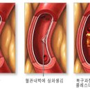 협심증의 통합자연요법 이미지