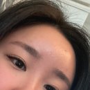 배곧피부과 추천 엘뷰티의원 이마필러 아픔 통증 후기