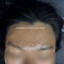 하이토탈뷰티 | 뷰티리셋 구월동 여드름 압출 재생관리 잘하는 곳 솔직후기