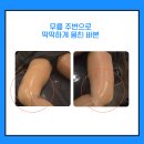 허벅지 바이오본드 로 딱딱해서 거동이 불편해요.