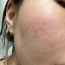 [피부과] 주름,턱,미간,콧볼 보톡스 &amp; 스킨보톡스 찐후기! 시술 잘하는 용인(기흥) 타토아의원 용인점