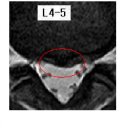 우산잉 님의 척추분리증, 요추디스크L4-5의 판독입니다. 이미지