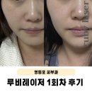 루비로 | 루비레이저 딱지 없이 주근깨 제거 후기 및 가격