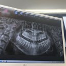 미지빌딩 | 잠실숲사랑니치과 발치 후기🦷