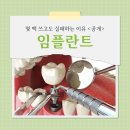 가우정인 | 구미산동치과, 임플란트 몇 백 쓰고도 실패하는 이유 <공개>