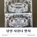 251023 당일 사랑니 발치 | 서울호치과, 연세사랑니치과의원
