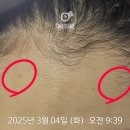 부천아이디의원 | 부천 아이디의원 피부과에서 제오민 보톡스 맞은후기