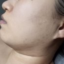 용산-211 | [용산 여드름 에스테틱] 여드름 치료 유목민, 정착하다 (내돈내산 후기, 비포애프터 사진 있음, 초이몽...