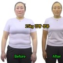 50대 중년여성 100kg 초고도비만 다이어트 25kg 감량