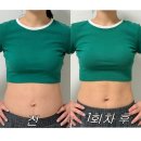 상상의원 | 날씬한 허리라인을 상상하며 방문한 지방분해주사의원 1회차 후기