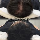 세심경로당 | 전주탈모커버 고민하다가 선택한 전주smp 후기, 생각보다 자연스러웠어요