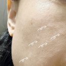 페이스라인성형외과의원 | 신논현역 튠페이스블루 리프팅후기및 부작용알려드려요[플레저성형외과의원2번째방문]