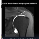 partial thickness tear of supraspinatus tendon 이미지