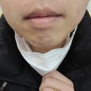 남자 얼굴 제모 후기(6회차)
