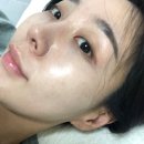 마이셀의원 | 셀리뉴 | 국산써마지 | 셀리뉴추천 내돈내산 전후 사진