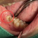 이오균치과의원 | [아산 연세원치과]구강 내 악취의 발원지, '사랑니 포켓'이 유발하는 생물학적 오염