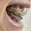 아(A)만두여기요 | 성인 치아교정 후기 상담부터 유지장치 까지 AtoZ