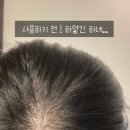 출산후탈모 고민이라면? 라보에이치 헤어라인 앰플 2주 사용 후기 (정수리 관리 시작!)