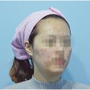 노아한의원 | 강남여드름피부과 한의원 피부 트러블 호전을 위해