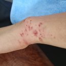 아세아정형외과의원 | 손목 바깥쪽 통증 (스테로이드 부작용 및 후기)