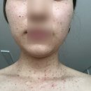 빗장미용실 | 합정] 연세보드미의원 편평사마귀 제거 2탄리얼후기 / 3일 후 일주일 후 한 달 후 관리, 얼굴상태...