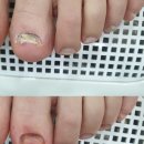 문제성발톱, 발톱무좀관리 다락방