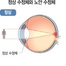 부천사랑안과의원 네이버블로그