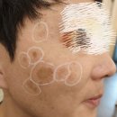 오빠가 간다 | 부산 흑자제거 깜놀 리얼 후기 (흑자투성이 사촌오빠 피부변화기!!)