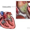 심내막염(Endocarditis) 이미지