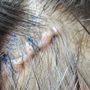 정헤어모드 | 여자 모발이식 M자탈모 헤어라인 절개 3500모 수술후기 3화 (집중관리기간 2~3일차)