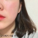 잡티제거 레이저시술 후기 / 점제거 2주관리 기록