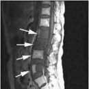 전이성 척추암 이미지