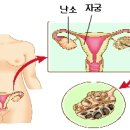 생리불순이 계속 된다면 의심해봐야 할 “다낭성 난소 증후군” 이미지