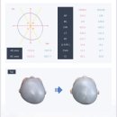 수정위례-D-13 | [비바 헬멧 위례 센터] 두상 3D 교정 헬멧 3회차 교정 후기 (사두증, 단두증 개선 효과)