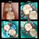 만수동치과 과잉진료 없는 보존적 치료후기: 사이충치 인레이 대신 레진 케이스