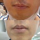 젠틀독 | 강남레이저제모로 경험한 젠틀프로맥스효과 9회차 찐 후기