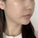 울쎄라프라임 300샷 효과 시기 울쎄라 후 통증 후기
