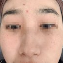 레이저 | 연신내피부과 기미 잡티 루비 색소레이저 후기