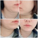 크린멍 | 해운대 센텀 인모드레이저 내돈내산 솔직후기