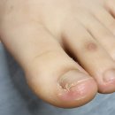 서울활짝편재활의학과의원 | 서울활짝편재활의학과｜양천구 내성발톱 치료 후기 (중3 아이 진료)