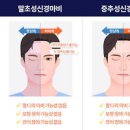 안면마비 원인, 구안와사 전조 및 (벨마비, 안면신경마비) 이미지