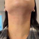 1회 사진기록전 | 다산역피부과 인모드FX 이중턱 시술 후기｜시술 과정과 1회차 변화 기록