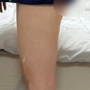 리바이브 | 강남역 다이어트 한의원에서 허벅지 리바이브 시술 리얼후기