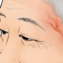 측두동맥염 [temporal arteritis] 이미지