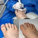 헬리오 명품세탁소 | 송파 발톱무좀 변색발톱 푸스케어 송파석촌점에서 관리후기