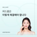 천마의원 | 포항양덕동피부과 여드름 케어, 제대로 하는 방법만 알아도됩니다 <의사작성>