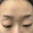 상현동피부관리 더에이치뷰티 재방문하여 아야필로 여드름흉터관리